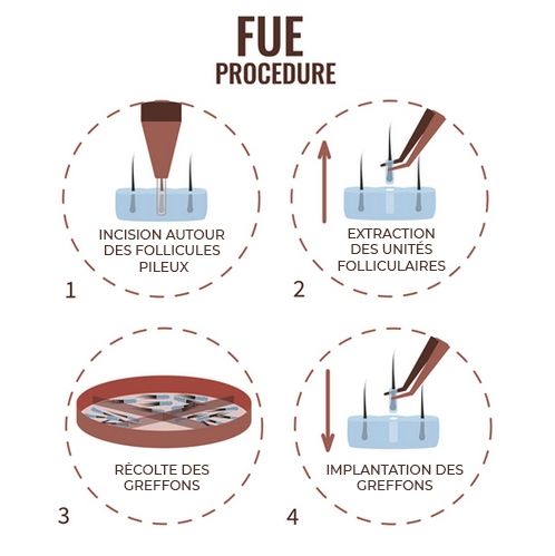 Procedure greffe de cheveux