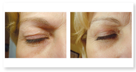 Résultat après traitement