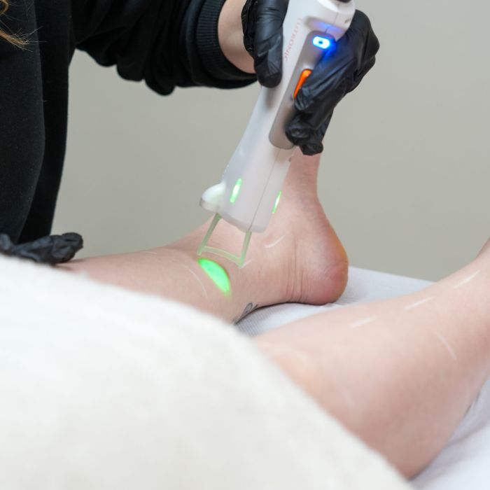 Laser vasculaire (YAG, IPL)
