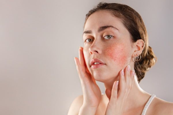 Lésions vasculaire sur les joues